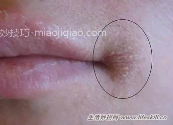 天冷上火,嘴角发炎怎么办?