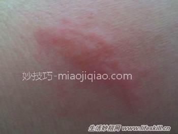 虱子咬人后症状,及如何清除虱子?