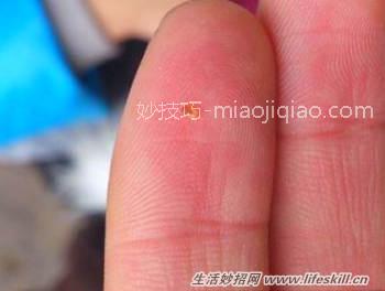 虱子咬人后症状,及如何清除虱子?