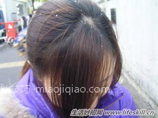 3种简单又健康的去屑小偏方